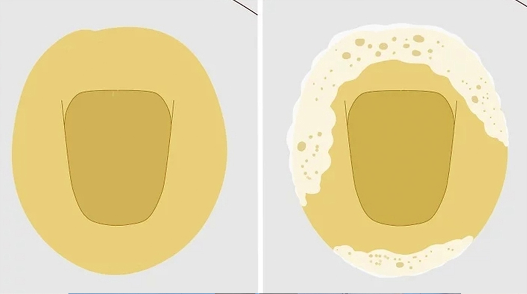 요단백
단백뇨
거품뇨